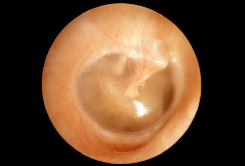 عفونت گوش 1