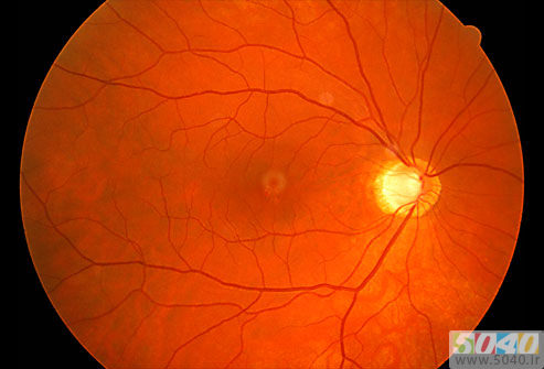 مشکلات و بیماری های چشمی و روش های شناسایی آن ها 1