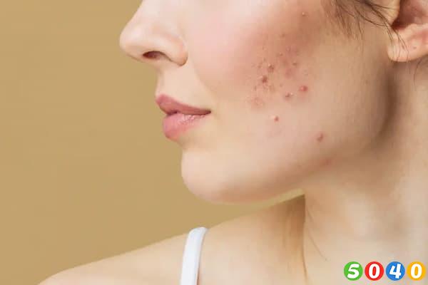 درمان آکنه-5040