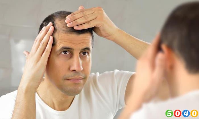 ریزش مو در مردان به علت عوامل ژنتیکی-5040