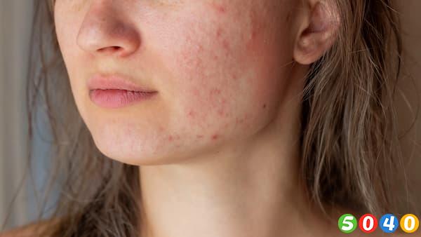 انواع لک پوستی و درمان آن-5040