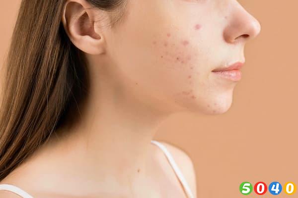 روتین کامل درمان لک و استفاده از کرم ضدلک-5040